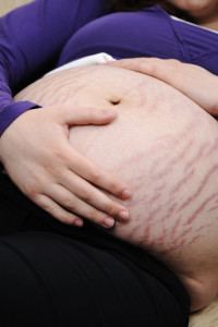 Causes and Treatment for Stretch Marks 1