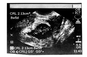 Seventh Through Tenth Weeks of Pregnancy, ultrasound