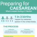 Preparing for a Caesarean Section: What to Expect