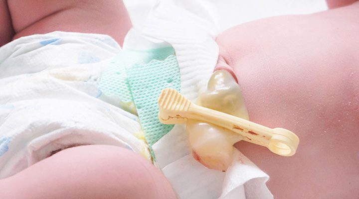 The Benefits of Delayed Cord Clamping  1