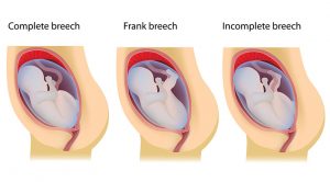 Three Types of Breech Presentations  1