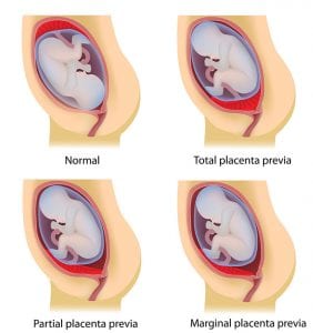 Everything You Need to Know About Placenta Previa 