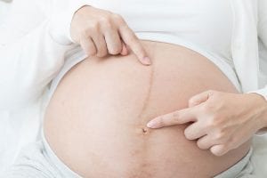 Understanding Linea Nigra; A Pregnant Belly’s Dark Line  1