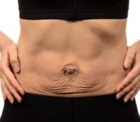 How to Identify and Treat Diastasis Recti 1