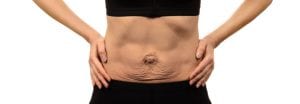 How to Identify and Treat Diastasis Recti 1