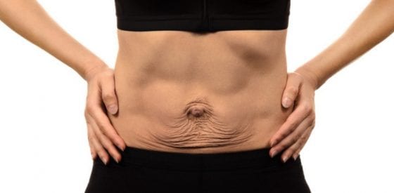 How to Identify and Treat Diastasis Recti 1