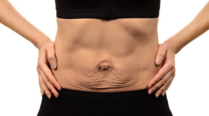 How to Identify and Treat Diastasis Recti 1