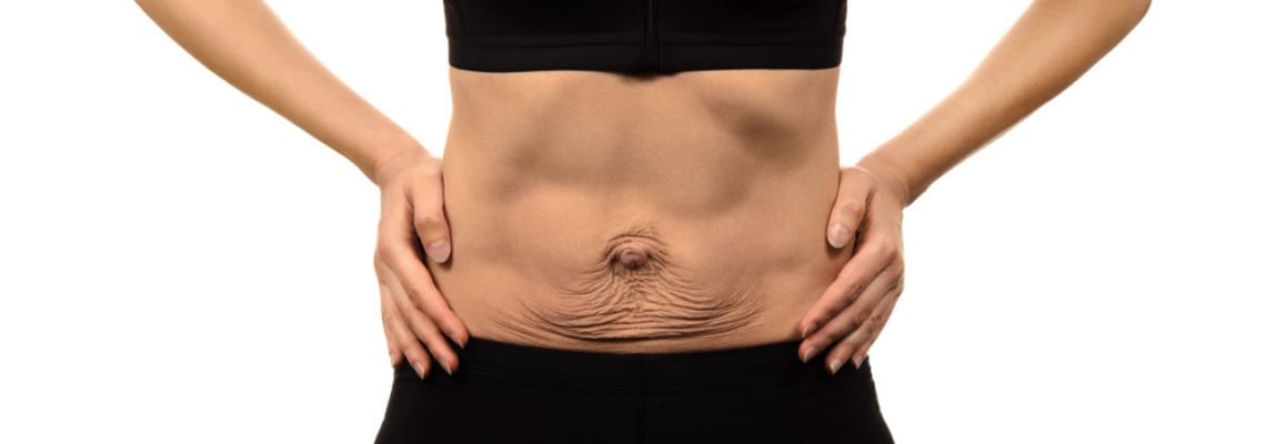 How to Identify and Treat Diastasis Recti 1