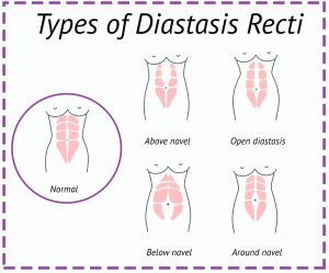 How to Identify and Treat Diastasis Recti 3