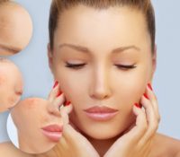 Melasma and Skin Health During Pregnancy