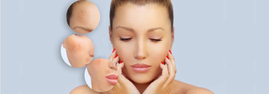 Melasma and Skin Health During Pregnancy