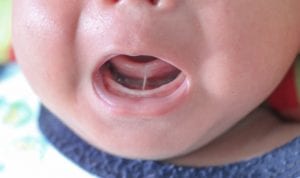 Understanding Baby Tongue-Ties and How to Correct Them