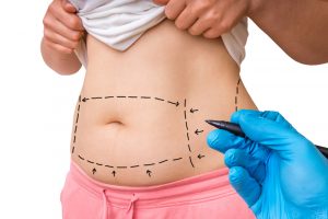 Tummy Tuck’s After Pregnancy - All You Need to Know 1