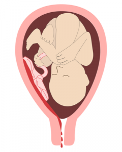 Placental Abruption: What to Know 1