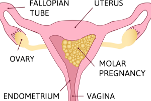 Molar Pregnancy: A Rare Pregnancy Complication