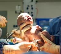 Do Babies Born by Cesarean Section Get Fewer Important Gut Bacteria?