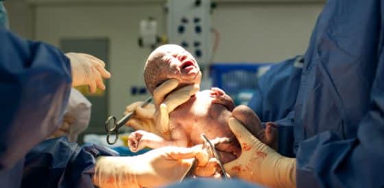 Do Babies Born by Cesarean Section Get Fewer Important Gut Bacteria?