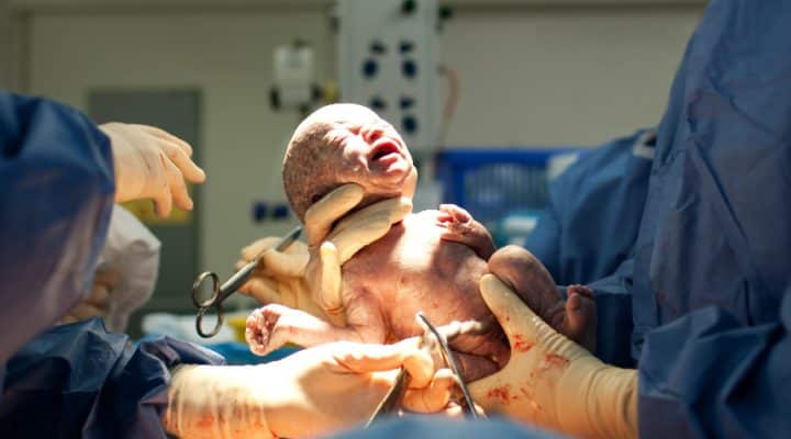 Do Babies Born by Cesarean Section Get Fewer Important Gut Bacteria?